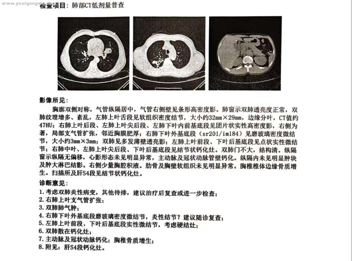 4月9日体检低剂量CT报告.jpg