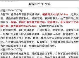 五次化免后多发淋巴结肿大，脑部新增病灶