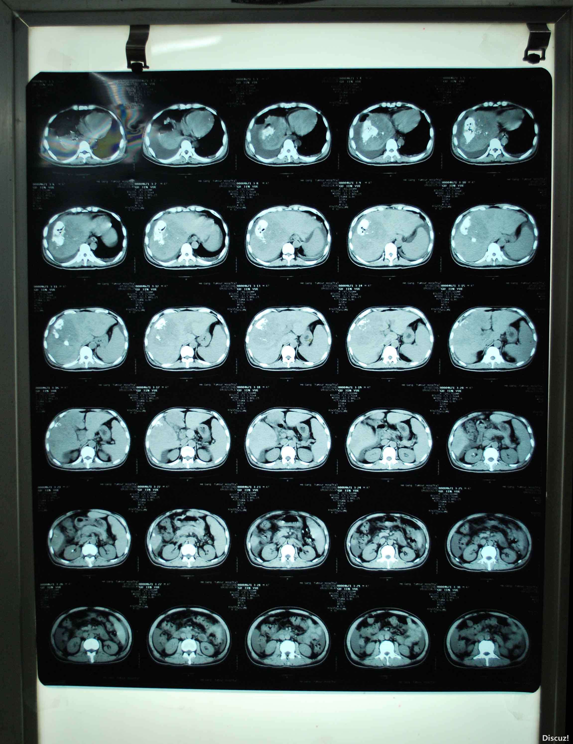 7月2号的CT